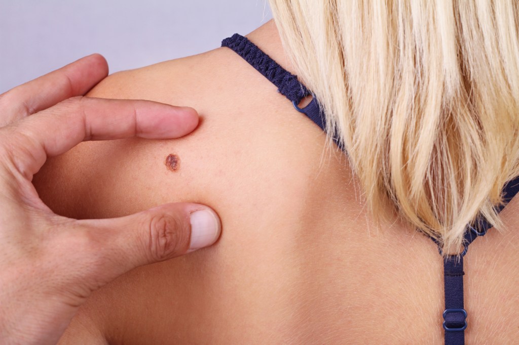 Mulher no médico examinando pinta Quando a pinta é perigosa?