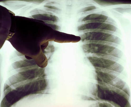 Fiocruz inscreve para especializa&ccedil;&atilde;o em Pneumologia Sanit&aacute;ria