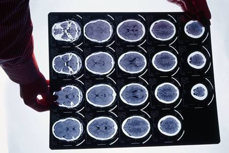 neuroimagem2.jpg UFSCar oferece especialização em Fisioterapia Neurofuncional